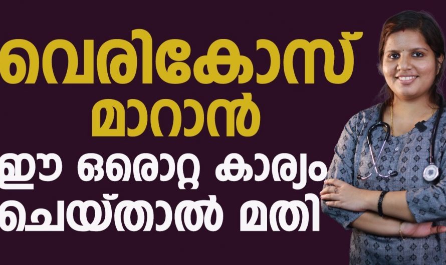 വെരിക്കോസ് വെയിനിനെ മരുന്നുകൾ ഇല്ലാതെ തന്നെ നമുക്ക് നേരിടാം. കണ്ടു നോക്കൂ…| vericose vein malayalam