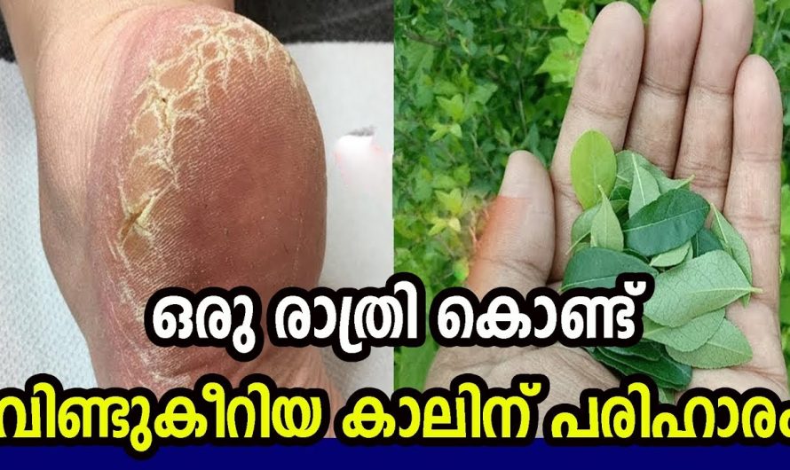 കാലിലെ വീണ്ടുകീറലിന്  ഇനി അസ്വസ്ഥയാകേണ്ട. പ്രതിവിധി ദാ ഇവിടെയുണ്ട് കണ്ടു നോക്കൂ.