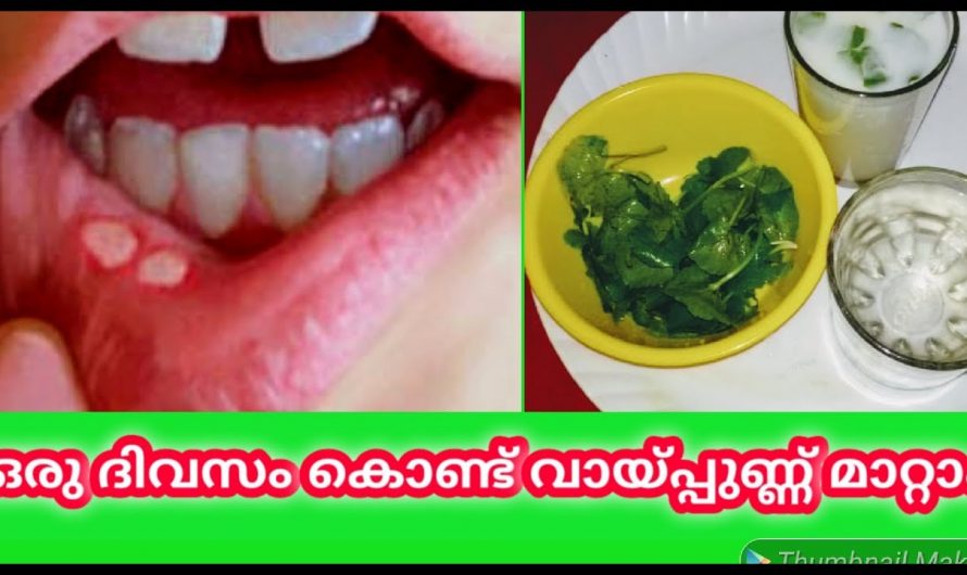 വായിപ്പുണ്ണ് നീങ്ങാൻ ഇനി മരുന്നുകളെ ആശ്രയിക്കേണ്ട. ഈ ഒരു ഇല മാത്രം മതി…| Mouth Ulcer Treatment Malayalam