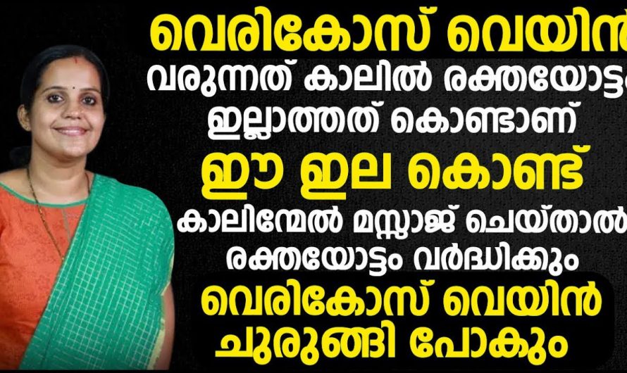 ജീവിതത്തിന്റെ താളം തെറ്റിക്കുന്ന വെരിക്കോസ് വെയിനിനെ കുറിച്ച് ആരും അറിയാതെ പോകരുതേ…| Varicose veins treatment