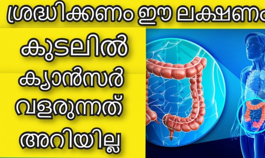 ഇത്തരം ലക്ഷണങ്ങൾ നിങ്ങളിൽ കാണപ്പെടാറുണ്ടോ? ഇത് അറിയാതെ പോയാൽ ജീവൻ തന്നെ നഷ്ടപ്പെടും…| Colon cancer stages