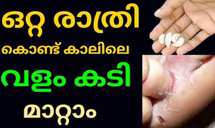 വളം കടി മാറ്റാൻ ഇത്രയ്ക്ക് എളുപ്പമായിരുന്നോ? ഇത്തരം അറിവുകൾ ആരും നിസ്സാരമായി കാണരുതേ.