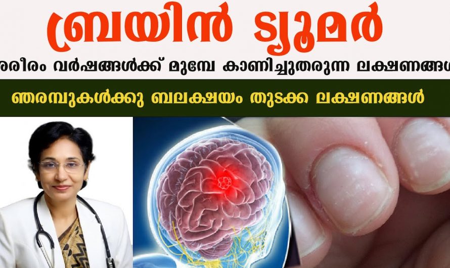 ബ്രെയിൻ ട്യൂമറെ ഇനി പേടിക്കാതെ തന്നെ തിരിച്ചറിഞ്ഞ പ്രതിരോധിക്കാം. കണ്ടു നോക്കൂ.