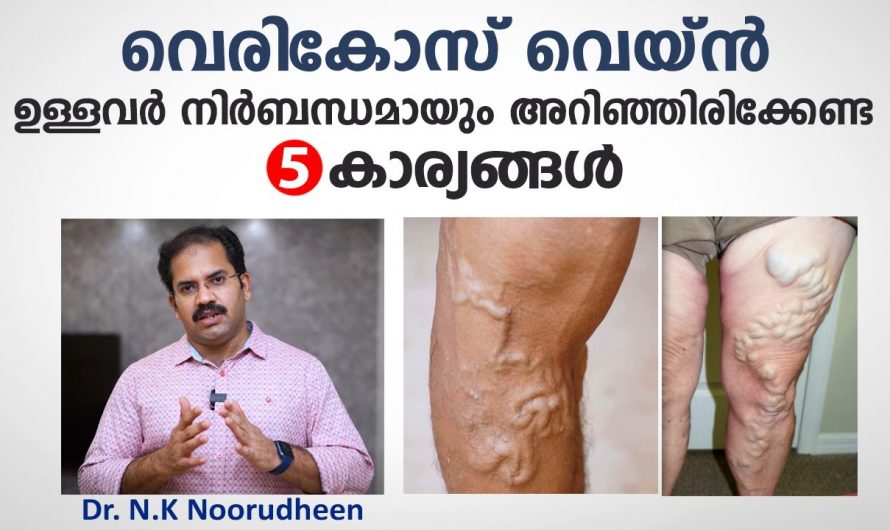 കാലുകളിൽ ഇത്തരം ലക്ഷണങ്ങൾ നിങ്ങളിൽ കാണുന്നുണ്ടോ? ഇവ നിസ്സാരമാക്കി കളയരുത്. കണ്ടു നോക്കൂ…| Varicose vein Malayalam Tips