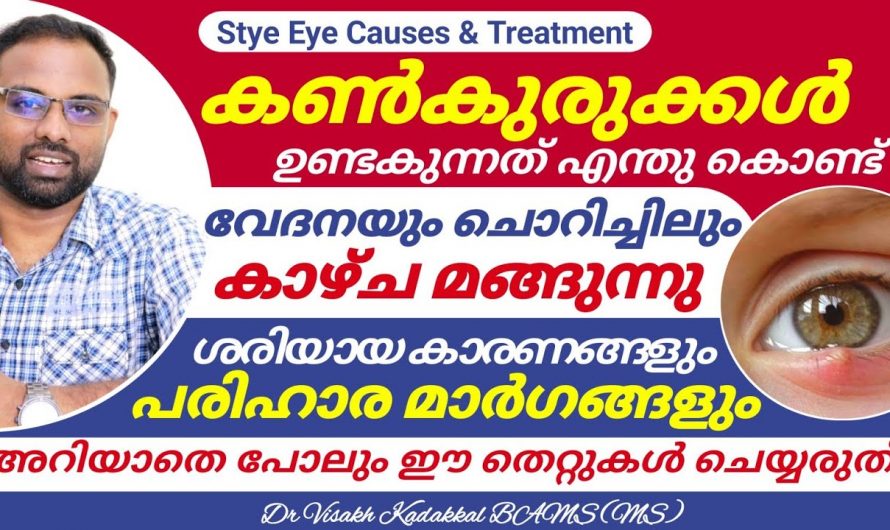 അടിക്കടിയായി കണ്ണിൽ കുരുക്കൾ പ്രത്യക്ഷപ്പെടാറുണ്ടോ ? ഇതിനെ ആരും നിസ്സാരമായി കാണരുതേ…| Eye stye treatment