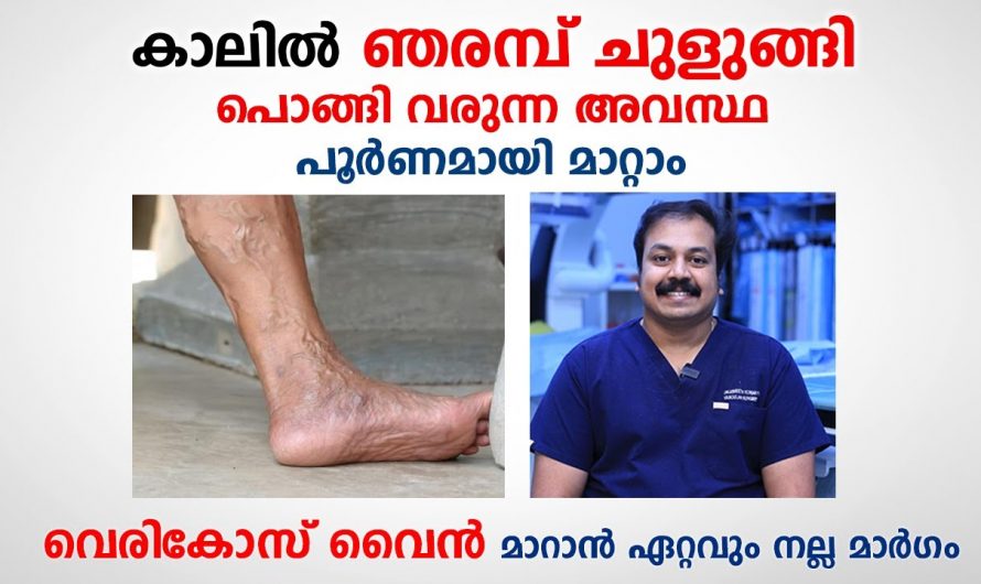 കാലുകളെ ബാധിക്കുന്ന വെരിക്കോസ് വെയിനിനെ ഇനി പേടിക്കേണ്ട. ഇതിന്റെ ചികിത്സയെക്കുറിച്ച് ആരും അറിയാതെ പോകല്ലേ.