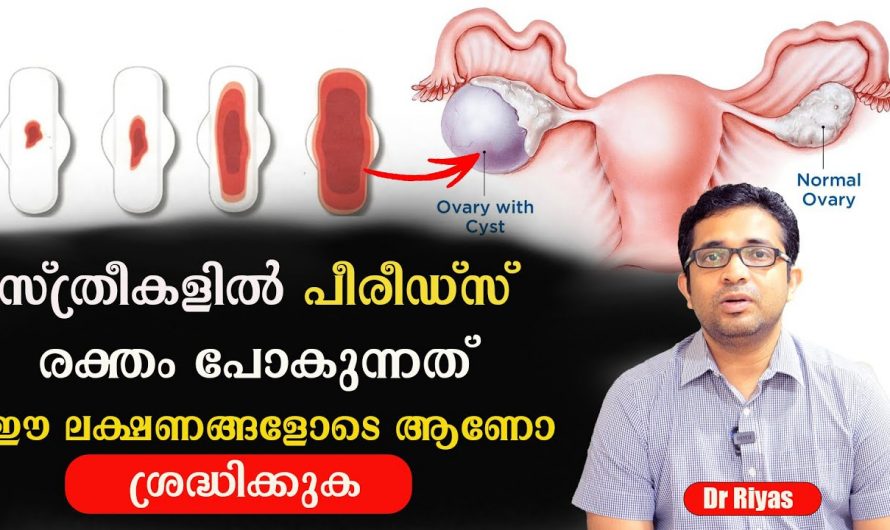 ആർത്തവസമയത്ത് അമിതമായ ബ്ലീഡിങ് ഉള്ളവരാണോ നിങ്ങൾ? എങ്കിൽ ഇത്തരം സാധ്യതകൾ തള്ളിക്കളയരുതേ.