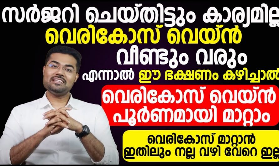 വെരിക്കോസ് വെയിനിനെ ശരീരം കാണിച്ചു തരുന്ന ഇത്തരം ലക്ഷണങ്ങളെ ആരും തിരിച്ചറിയാതിരിക്കരുതേ…| Varicose vein pain relief