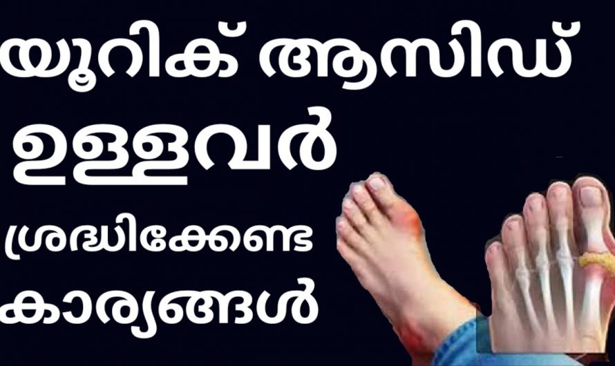 ഭക്ഷണത്തിൽ ഇത്തരം മാറ്റങ്ങൾ കൊണ്ടുവരൂ. യൂറിക് ആസിഡിന് പൂർണമായും പുറന്തള്ളാo. കണ്ടു നോക്കൂ…| Uric acid symptoms