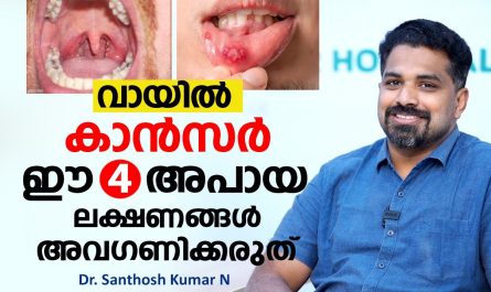 First 3 signs of mouth cancer pictures