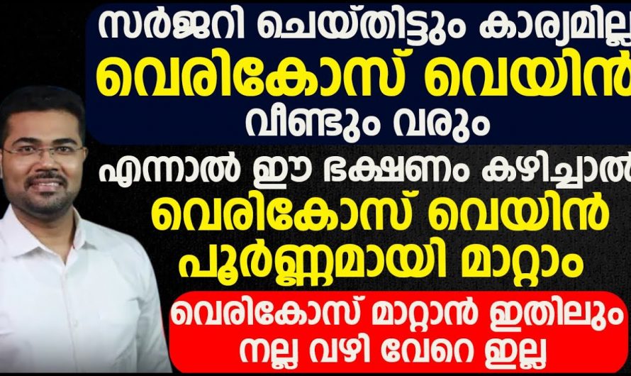 മരുന്നുകൾ എത്ര എടുത്താലും വേരിക്കോസ് മാറില്ല.അതിനെ ഇത്തരം കാര്യങ്ങൾ ചെയ്തേ മതിയാവൂ. കണ്ടു നോക്കൂ.