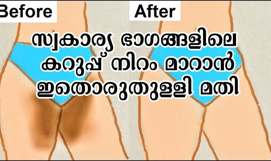 സ്വകാര്യ ഭാഗങ്ങളിലെ കറുപ്പുനിറം നിങ്ങളിൽ ബുദ്ധിമുട്ടുണ്ടാക്കുന്നുണ്ടോ? ഇതിനെ മറികടക്കാൻ ഒരൊറ്റ തുള്ളി മതി കണ്ടു നോക്കൂ…| Remedy for private parts darkness