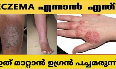 Eczema Treatment in Malayalam