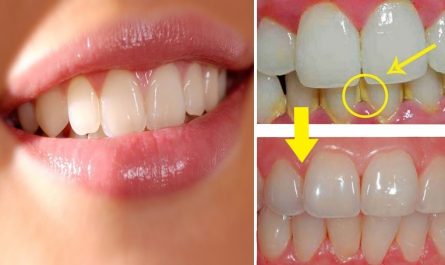 How to get perfect teeth