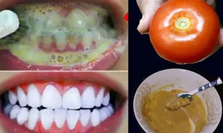 Teeth Whitening Malayalam