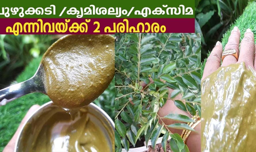 ഒരുപാട് പോലും അവശേഷിക്കാതെ ചർമ്മത്ത് ഉണ്ടാകുന്ന അണുബാധകളെ തടയാൻ ഇത് മാത്രം മതി. കണ്ടു നോക്കൂ…| Fungal Infection and Itching Remady