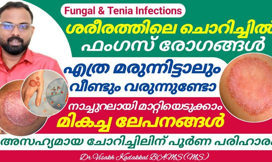 ചർമ്മത്ത് ഉണ്ടാകുന്ന ഫംഗസ് രോഗങ്ങളുടെ യഥാർത്ഥ കാരണങ്ങളേയും പ്രതിവിധികളെയും ആരും തിരിച്ചറിയാതെ പോകരുതേ.