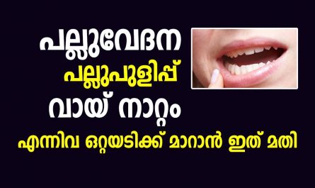 Home Remedies for Toothache