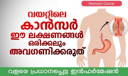 Stomach cancer symptoms