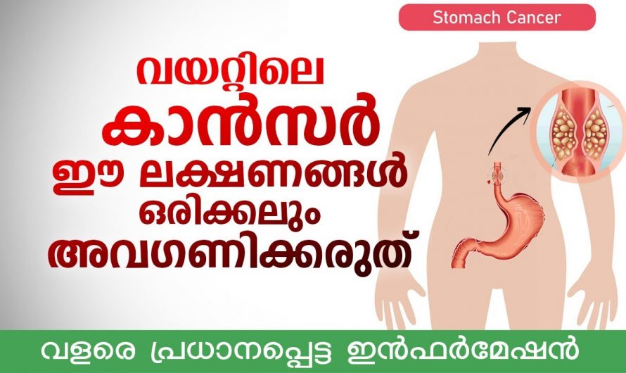 വയറ്റിലെ ക്യാൻസറിനെ ശരീരം പ്രകടമാക്കുന്ന ഇത്തരം ലക്ഷണങ്ങളെ തിരിച്ചറിയാതെ പോയാൽ തീരാ നഷ്ടമായിരിക്കും ഫലം. കണ്ടു നോക്കൂ…| Stomach cancer symptoms