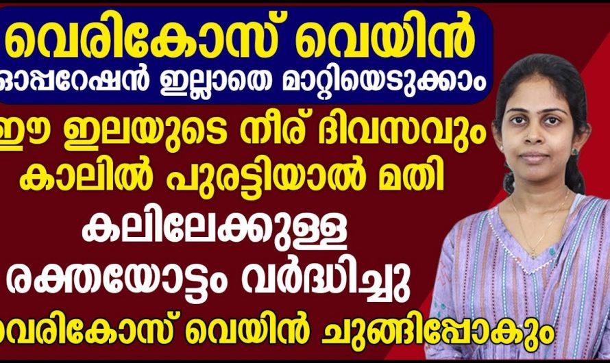 സർജറി പോലുമില്ലാതെ വെരിക്കോസിനെ പൂർണമായി മാറ്റുന്നതിന് ഇത്തരം കാര്യങ്ങൾ ആരും അറിയാതെ പോകല്ലേ.