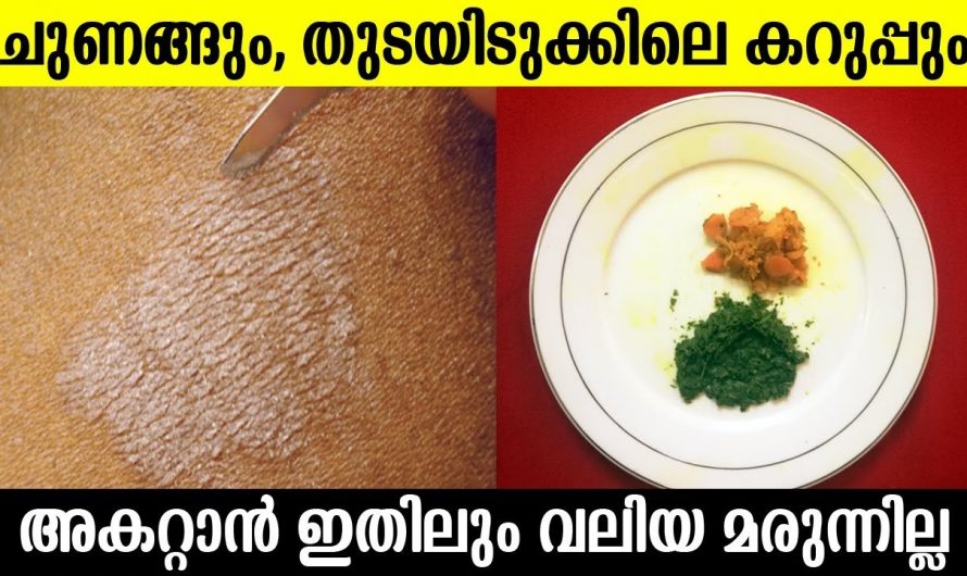 ശരീരത്തിലെ ചുണങ്ങിനെ നീക്കം ചെയ്യാൻ ഇതിനുള്ള കഴിവ് മറ്റൊന്നിനുമില്ല. കണ്ടു നോക്കൂ…| Get Rid of Tinea Versicolor