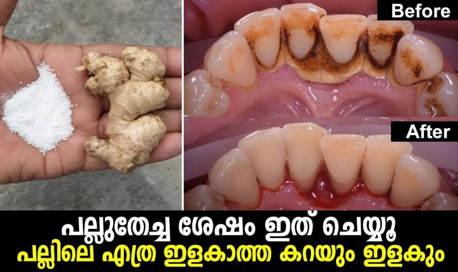 പല്ലിലെ കറ കളയാൻ ഇത്രയ്ക്ക് എളുപ്പമായിരുന്നോ? ഇതാരും കാണാതെ പോകരുതേ.