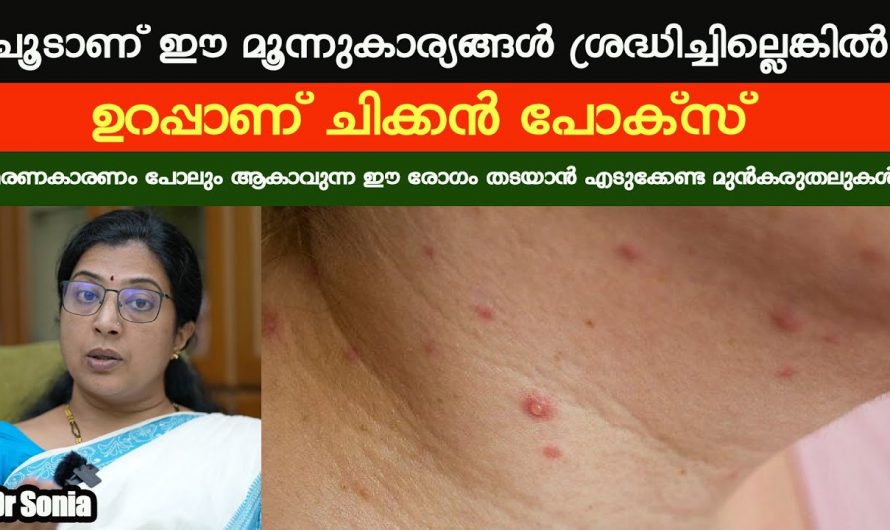 ചിക്കൻപോക്സിനെ തിരിച്ചറിയാനും പ്രതിരോധിക്കാനും ഇത്തരം കാര്യങ്ങൾ ആരും അറിയാതെ പോകല്ലേ.