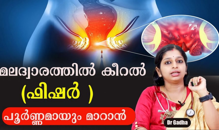 വേദനാജനകമായ ഫിഷറിനെ മറികടക്കാൻ ഇത്രമാത്രം ചെയ്താൽ മതി. ഇതാരും നിസ്സാരമായി കാണരുതേ.