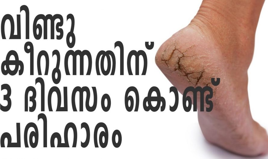 കാൽ വിണ്ടുകീറുന്നതാണോ നിങ്ങളുടെ പ്രശ്നം? എങ്കിൽ സൊലൂഷൻ ദാ ഇവിടെയുണ്ട്. കണ്ടു നോക്കൂ…| Home Remedies For Cracked Heels