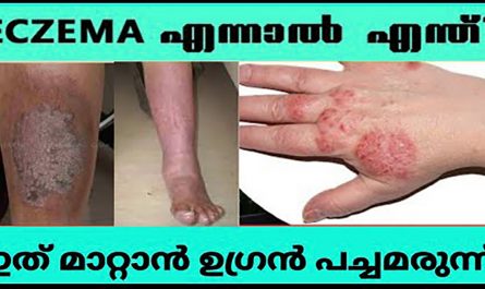 Eczema Treatment in Malayalam Remady