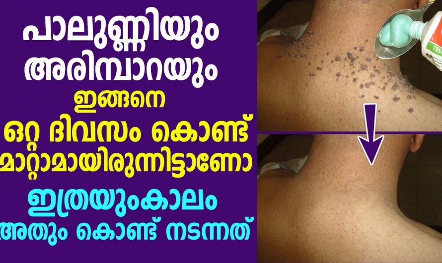 ചർമ്മത്തിലെ എത്ര അരിമ്പാറയെയും പാലുണ്ണിയെയും നിമിഷം നേരം കൊണ്ട് അകറ്റാൻ ഇതു മതി. കണ്ടു നോക്കൂ…| Warts removal treatment