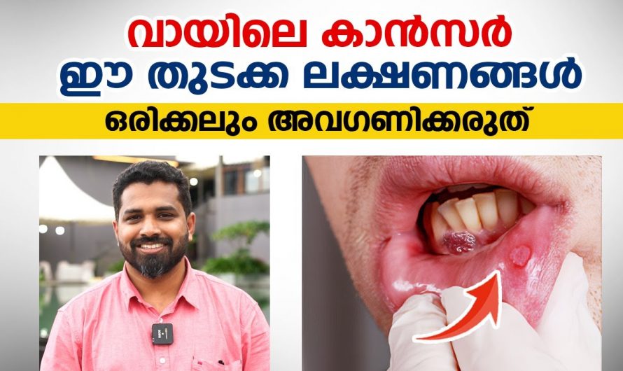 വായയിലെ ക്യാൻസറിന്റെ ലക്ഷണങ്ങളെ അറിയാതെ പോയാൽ തീരാനഷ്ടം ആയിരിക്കും ഫലം. കണ്ടു നോക്കൂ.