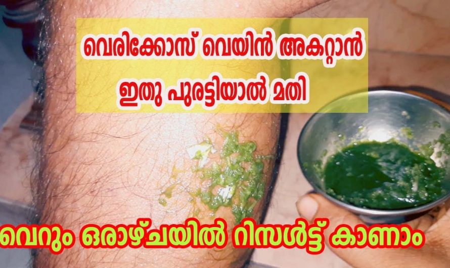 കാലിലേക്കുള്ള രക്തയോട്ടം വർദ്ധിപ്പിക്കാൻ ഈയൊരു മിശ്രിതം മതി.  ഇതാരും അറിയാതെ പോകരുതേ…| Home Remedies for Varicose Veins