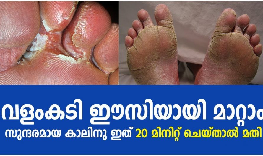 ഒരൊറ്റ യൂസിൽ തന്നെ വളം കടിയെ പൂർണമായി ഭേദമാക്കാൻ ഇത് മാത്രം മതി. ഇതാരും നിസ്സാരമായി കാണല്ലേ.