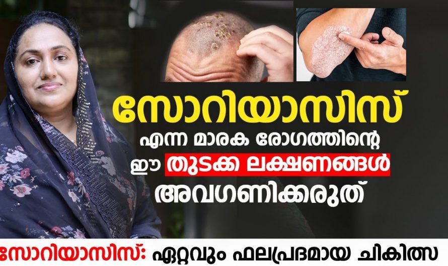 സോറിയാസിസിനെ ശരീരം കാണിക്കുന്ന ലക്ഷണങ്ങളെ ആരും അറിയാതെ പോകല്ലേ…| Treat Psoriasis in Ayurveda