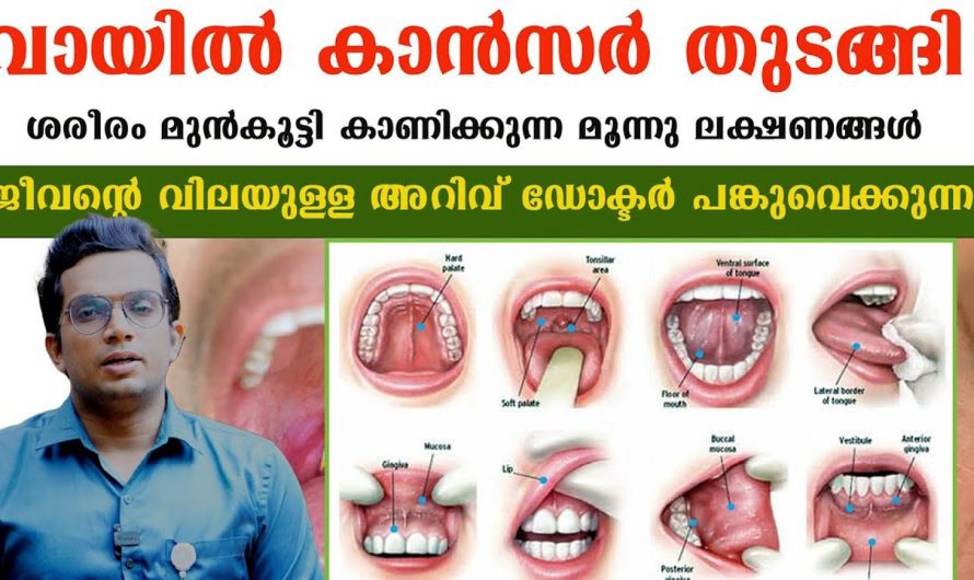 വായയിലെ കാൻസറിന്റെ കാരണങ്ങളും ലക്ഷണങ്ങളും ആരും തിരിച്ചറിയാതെ പോകരുതേ.