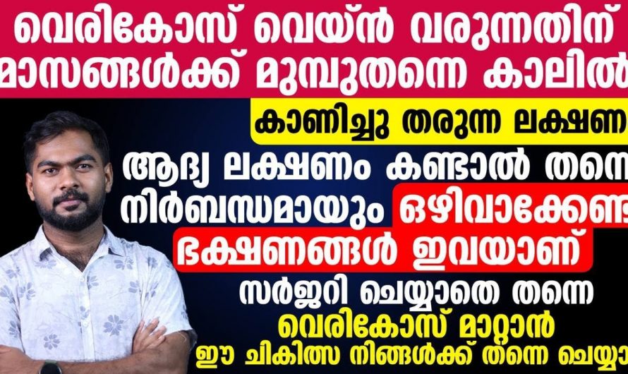 വെരിക്കോസിനെ മറികടക്കാൻ ഇനി സർജറിയുടെ ആവശ്യമില്ല. കണ്ടു നോക്കൂ…| To remove varicose veins