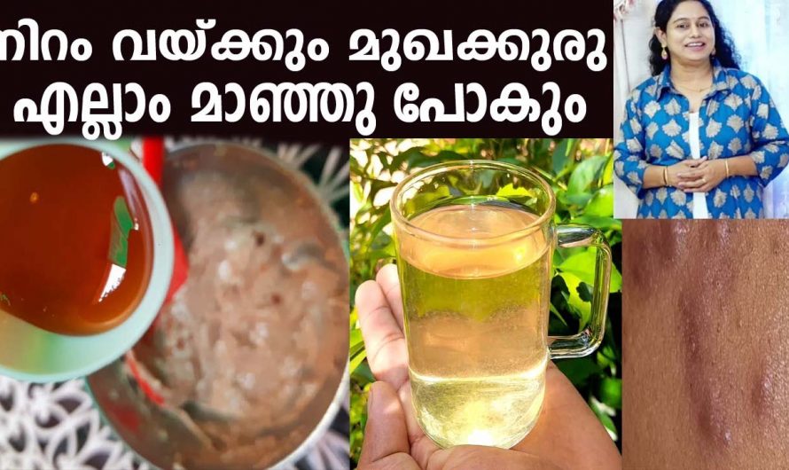 മുഖക്കുരു, കരിമംഗല്യം മാറ്റുവാനും നിറം വയ്ക്കുവാനും ഇത് ഉപയോഗിച്ചാൽ മതി. കണ്ടു നോക്കൂ.