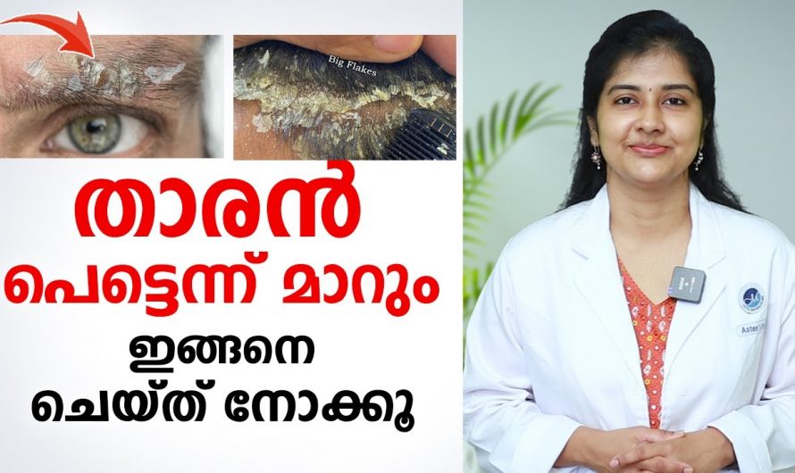 താരൻ എന്ന പ്രശ്നത്തെ എന്നന്നേക്കുമായി തുടച്ചുനീക്കാൻ ഇതാരും കാണാതെ പോകല്ലേ…| Dandruff Treatment at Home