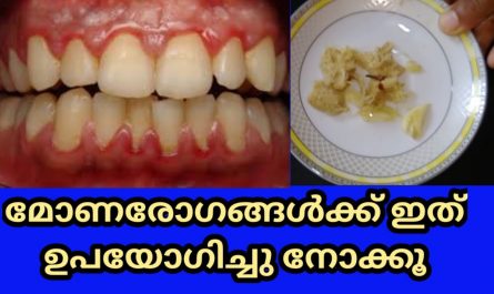 Dental Infection Treatment